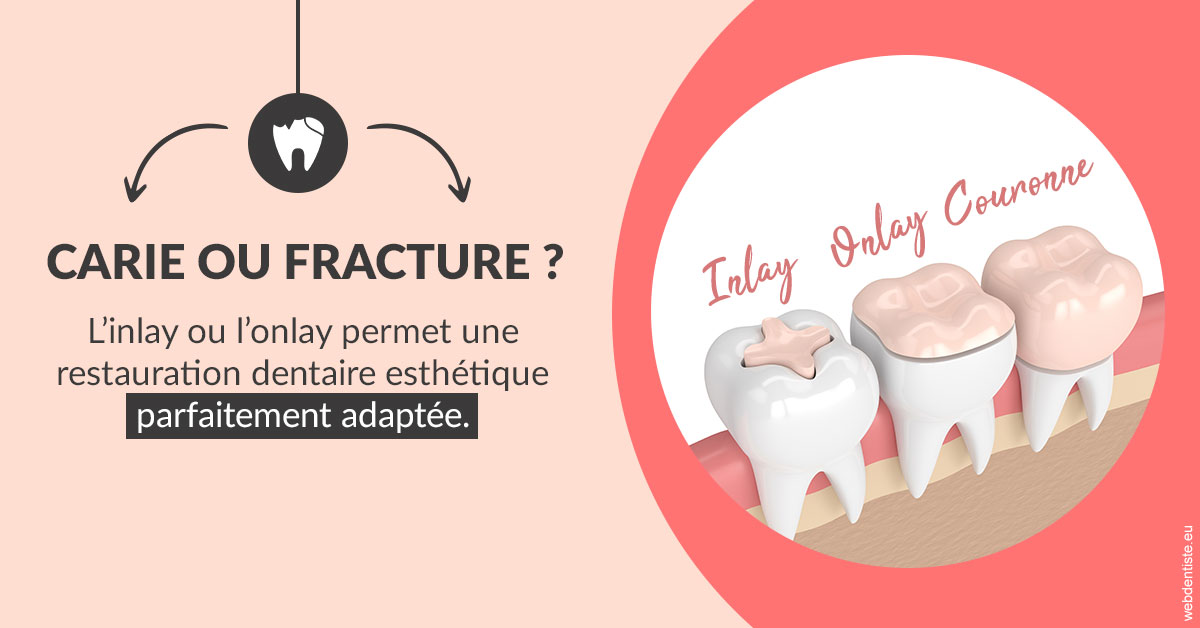 https://selarl-elysees-berri.chirurgiens-dentistes.fr/T2 2023 - Carie ou fracture 2