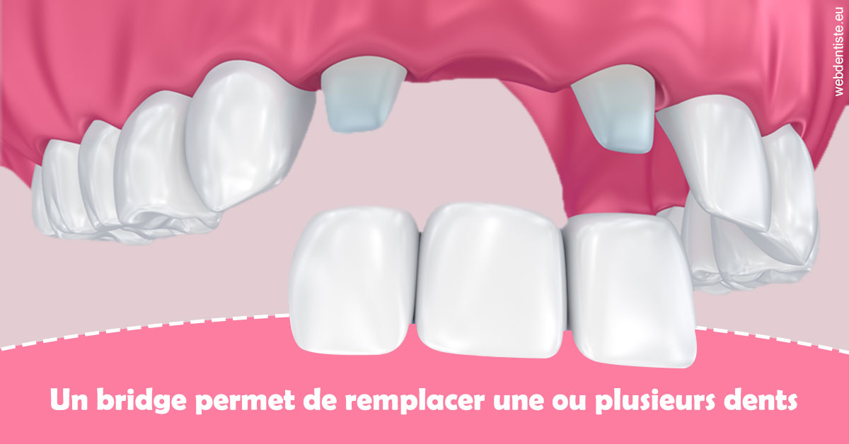 https://selarl-elysees-berri.chirurgiens-dentistes.fr/Bridge remplacer dents 2