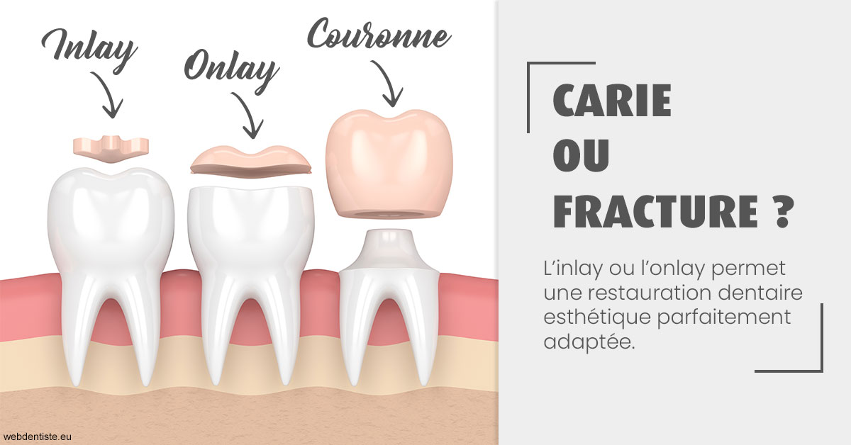 https://selarl-elysees-berri.chirurgiens-dentistes.fr/T2 2023 - Carie ou fracture 1